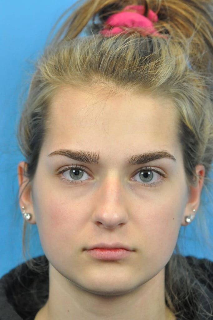 Rhinoplasty Before and After Pictures Indianapolis, IN