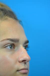 Rhinoplasty Before and After Pictures Indianapolis, IN