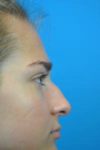 Rhinoplasty Before and After Pictures Indianapolis, IN