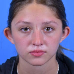 Otoplasty Before and After Pictures Indianapolis, IN