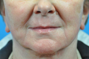 SCITON LASER BEFORE & AFTER PICTURES IN INDIANAPOLIS, INDIANA
