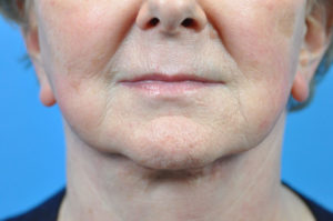 SCITON LASER BEFORE & AFTER PICTURES IN INDIANAPOLIS, INDIANA