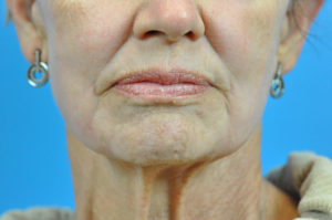 CO2 Laser Before & After Pictures in Indianapolis, Indiana