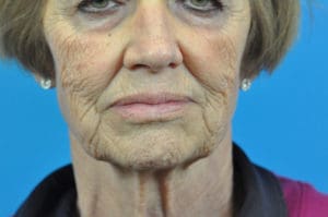 CO2 Laser Before & After Pictures in Indianapolis, Indiana