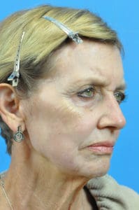 CO2 Laser Before & After Pictures in Indianapolis, Indiana