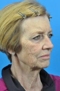 CO2 Laser Before & After Pictures in Indianapolis, Indiana
