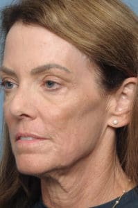 CO2 Laser Before & After Pictures in Indianapolis, Indiana