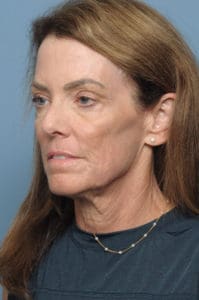 CO2 Laser Before & After Pictures in Indianapolis, Indiana
