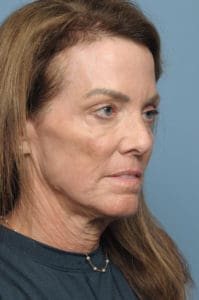 CO2 Laser Before & After Pictures in Indianapolis, Indiana