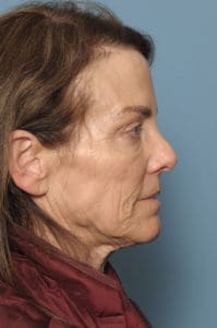 CO2 Laser Before & After Pictures in Indianapolis, Indiana