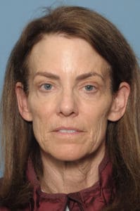 CO2 Laser Before & After Pictures in Indianapolis, Indiana