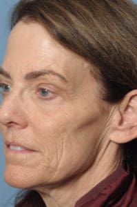 CO2 Laser Before & After Pictures in Indianapolis, Indiana