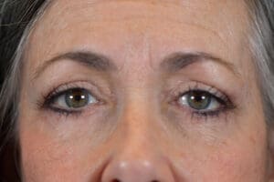 Blepharoplasty Before and After Pictures Indianapolis, IN