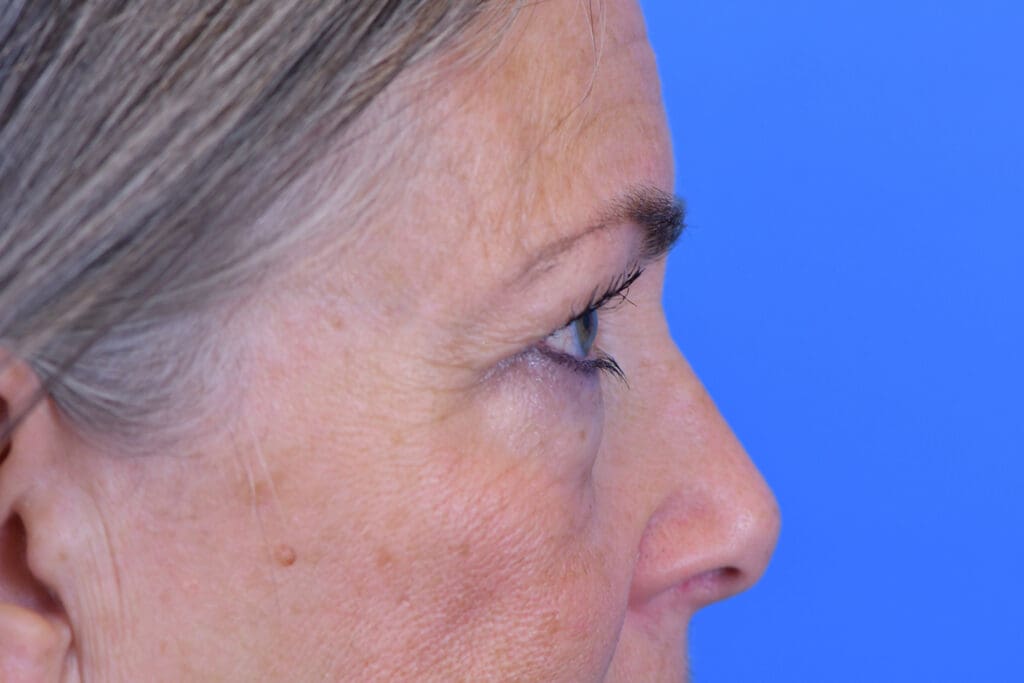 Blepharoplasty Before and After Pictures Indianapolis, IN