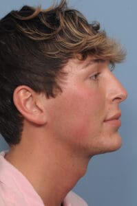 Rhinoplasty Before and After Pictures Indianapolis, IN
