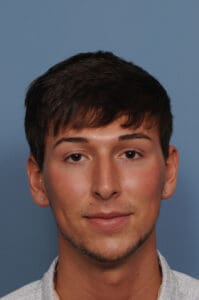 Rhinoplasty Before and After Pictures Indianapolis, IN