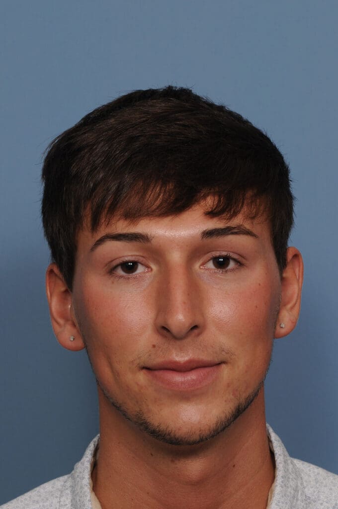 Rhinoplasty Before and After Pictures Indianapolis, IN