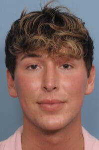 Rhinoplasty Before and After Pictures Indianapolis, IN