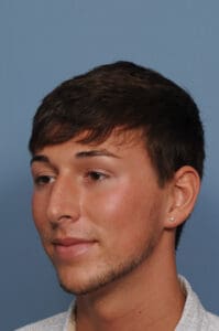 Rhinoplasty Before and After Pictures Indianapolis, IN