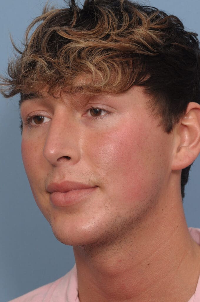 Rhinoplasty Before and After Pictures Indianapolis, IN