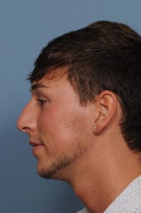 Rhinoplasty Before and After Pictures Indianapolis, IN