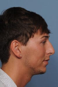 Rhinoplasty Before and After Pictures Indianapolis, IN