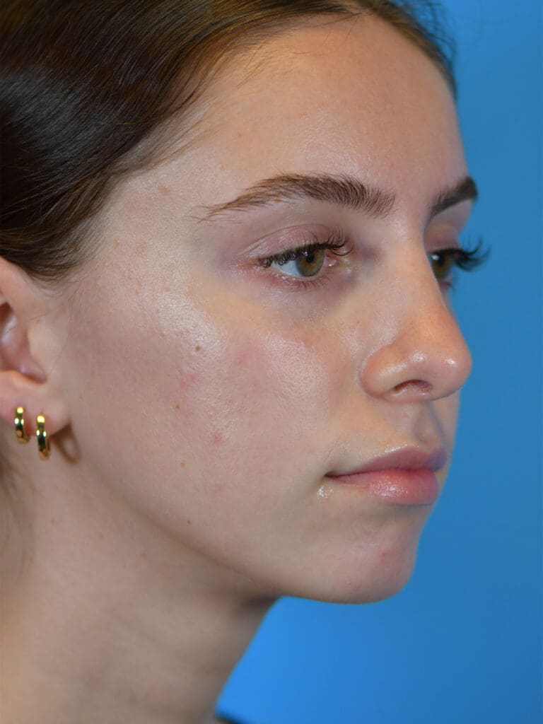 Rhinoplasty Before and After Pictures Indianapolis, IN