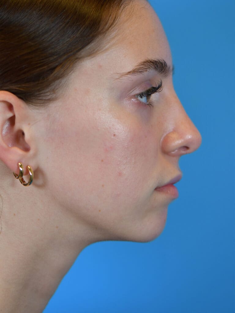 Rhinoplasty Before and After Pictures Indianapolis, IN