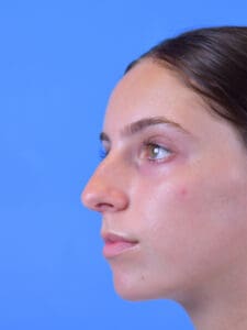 Rhinoplasty Before and After Pictures Indianapolis, IN