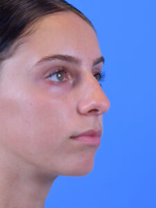 Rhinoplasty Before and After Pictures Indianapolis, IN
