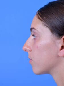 Rhinoplasty Before and After Pictures Indianapolis, IN