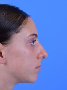 Rhinoplasty Before and After Pictures Indianapolis, IN