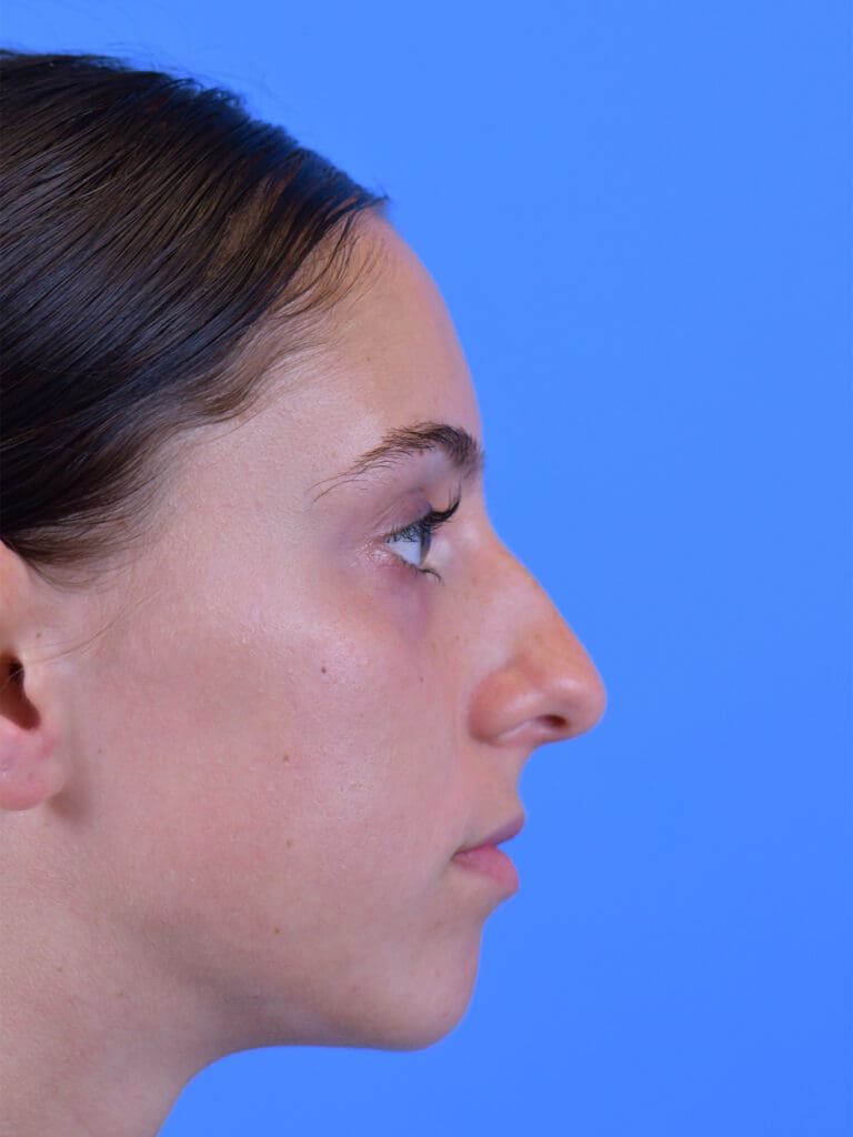 Rhinoplasty Before and After Pictures Indianapolis, IN