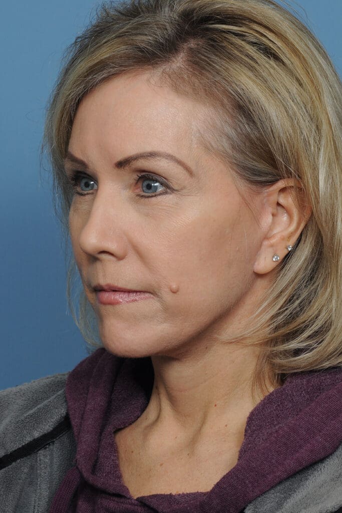 Facelift Before and After Pictures Indianapolis, IN