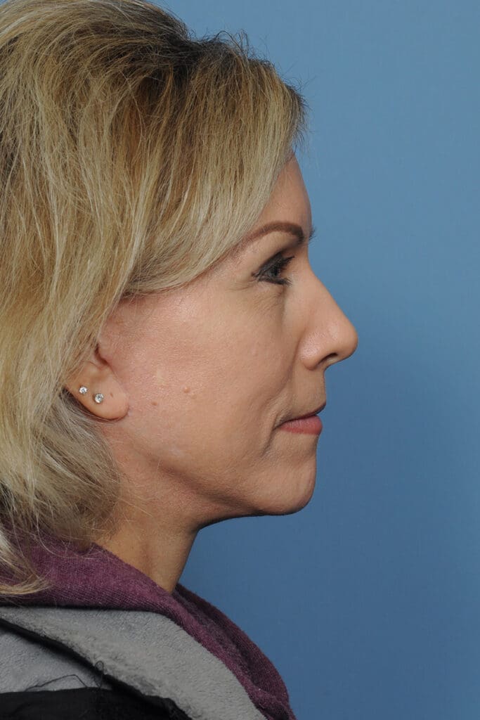 Facelift Before and After Pictures Indianapolis, IN