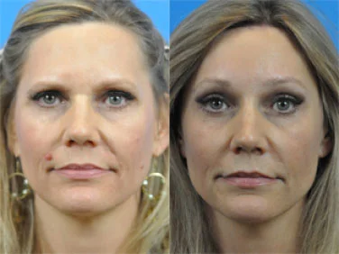 browlift Hamilon Facial Plastic Surgery
