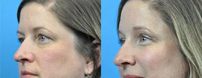 Hamilon Facial Plastic Surgery