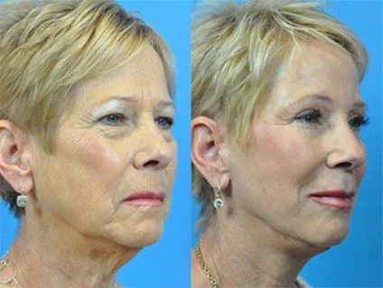 facelift Hamilon Facial Plastic Surgery