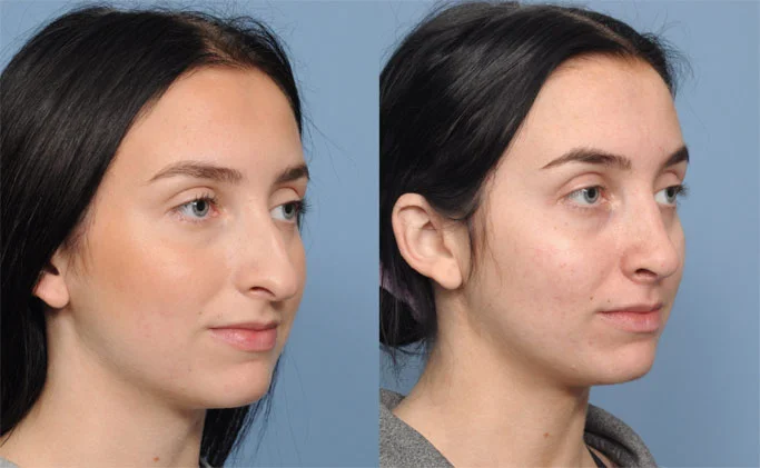 rhinoplasty Hamilon Facial Plastic Surgery