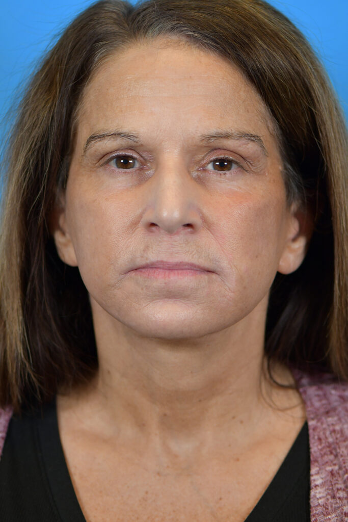 Facelift Before and After Pictures Indianapolis, IN