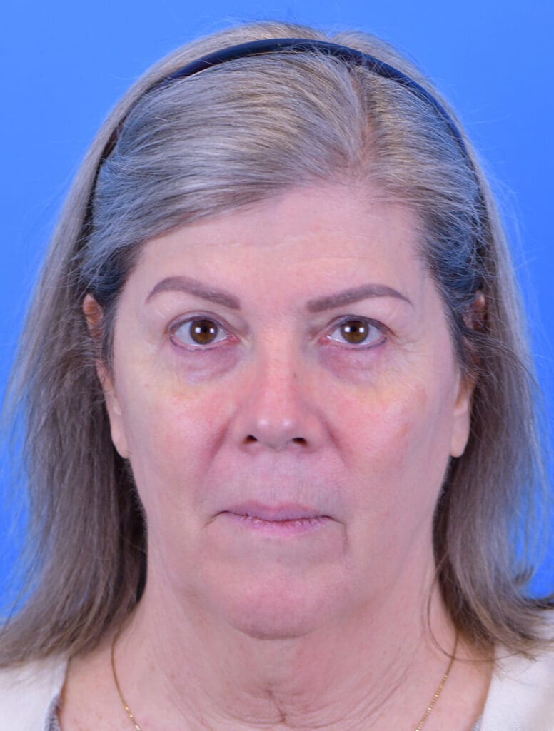 Facelift Before and After Pictures Indianapolis, IN
