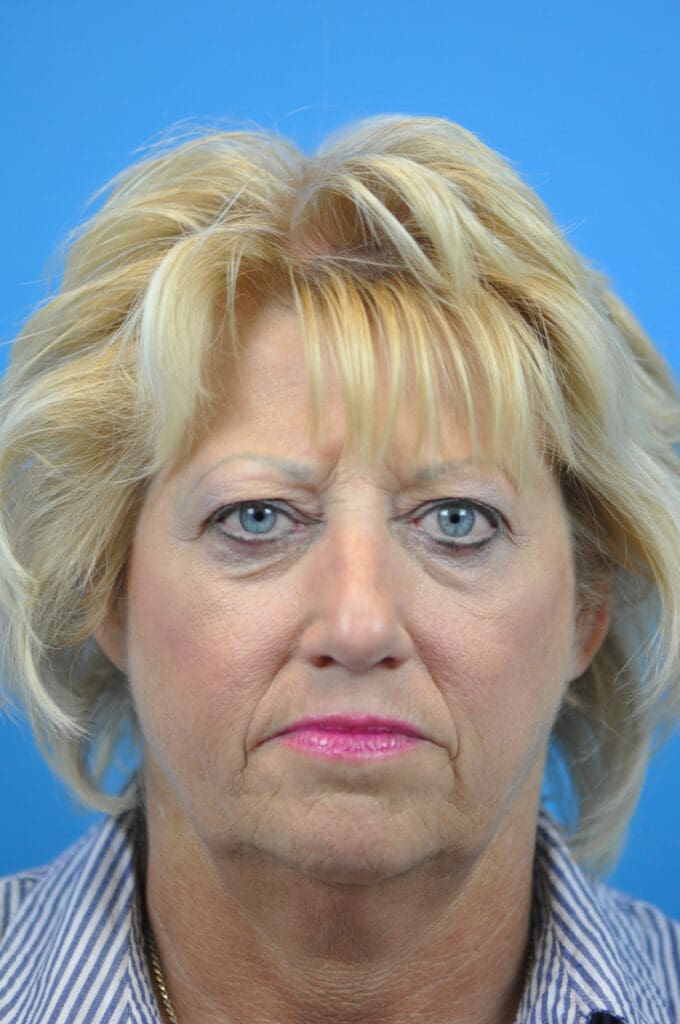 Facelift Before and After Pictures Indianapolis, IN