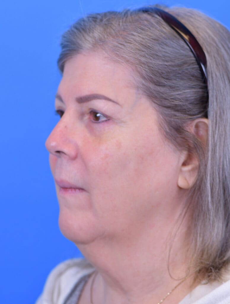 Facelift Before and After Pictures Indianapolis, IN