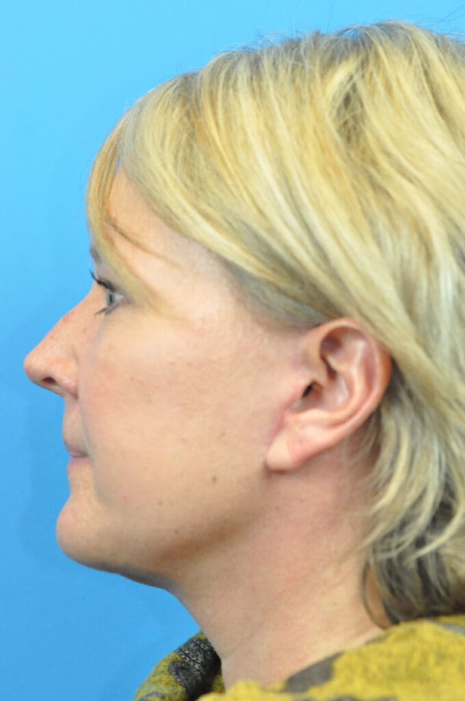 Facelift Before and After Pictures Indianapolis, IN
