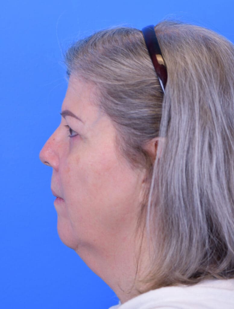 Facelift Before and After Pictures Indianapolis, IN
