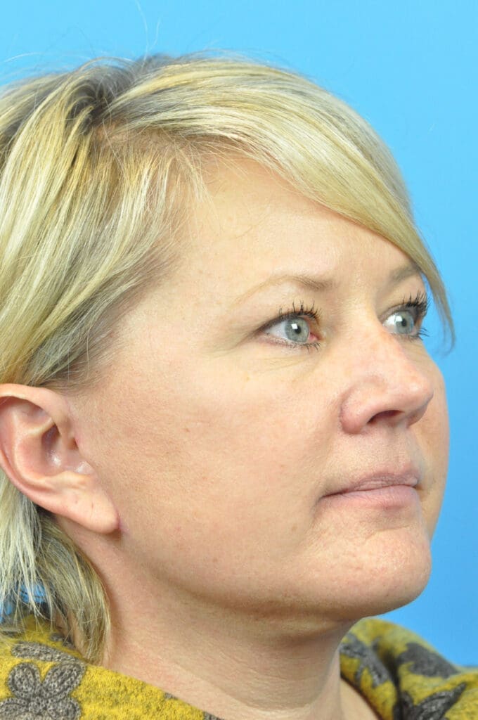 Facelift Before and After Pictures Indianapolis, IN