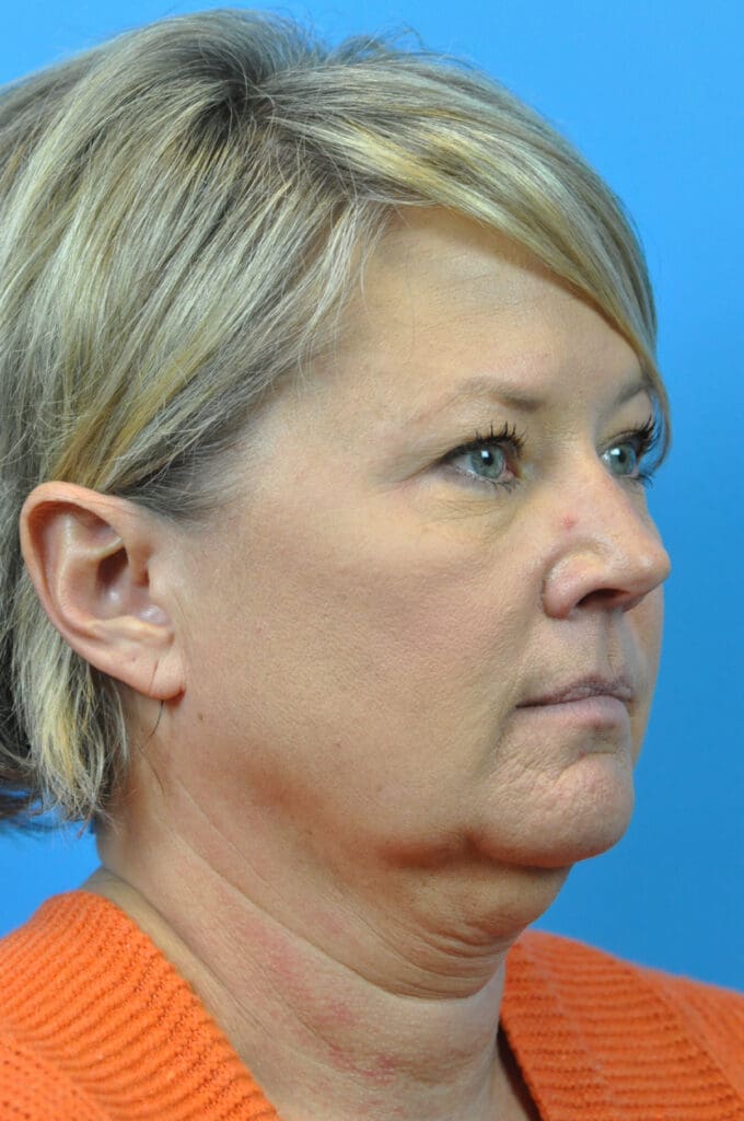 Facelift Before and After Pictures Indianapolis, IN