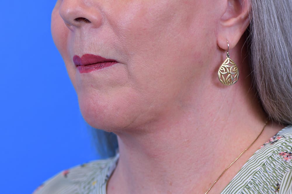 Facelift Before and After Pictures Indianapolis, IN