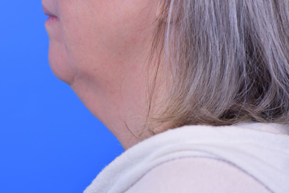 Facelift Before and After Pictures Indianapolis, IN