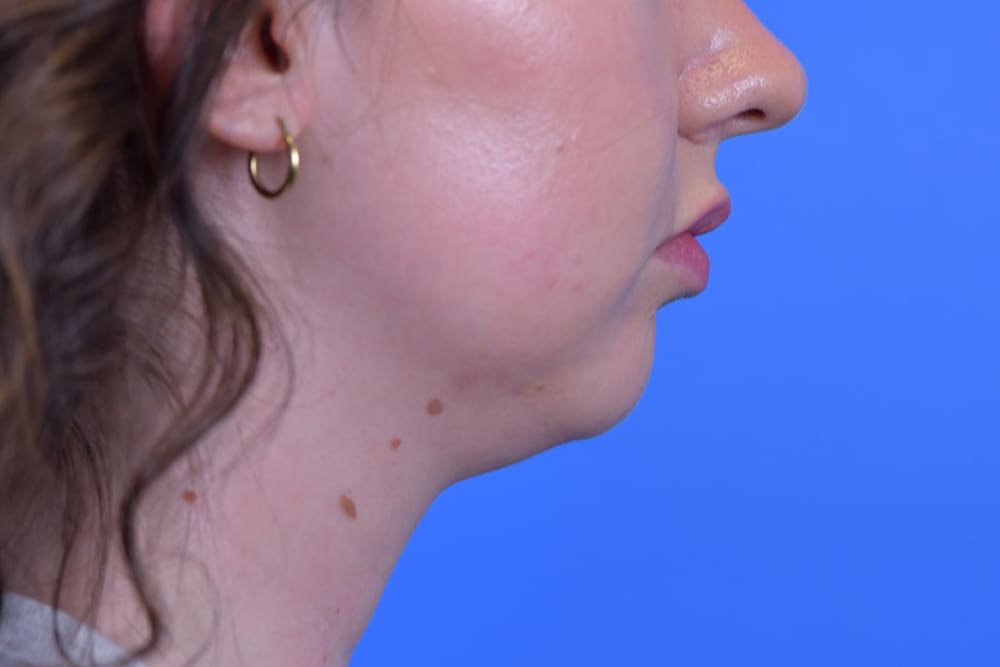 Facelift Before and After Pictures Indianapolis, IN